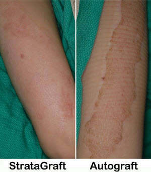 Picture of two arms with skin grafts, one with StrataGraft and one with an autograft.  Healing is much more effective on the arm with StrataGraft.